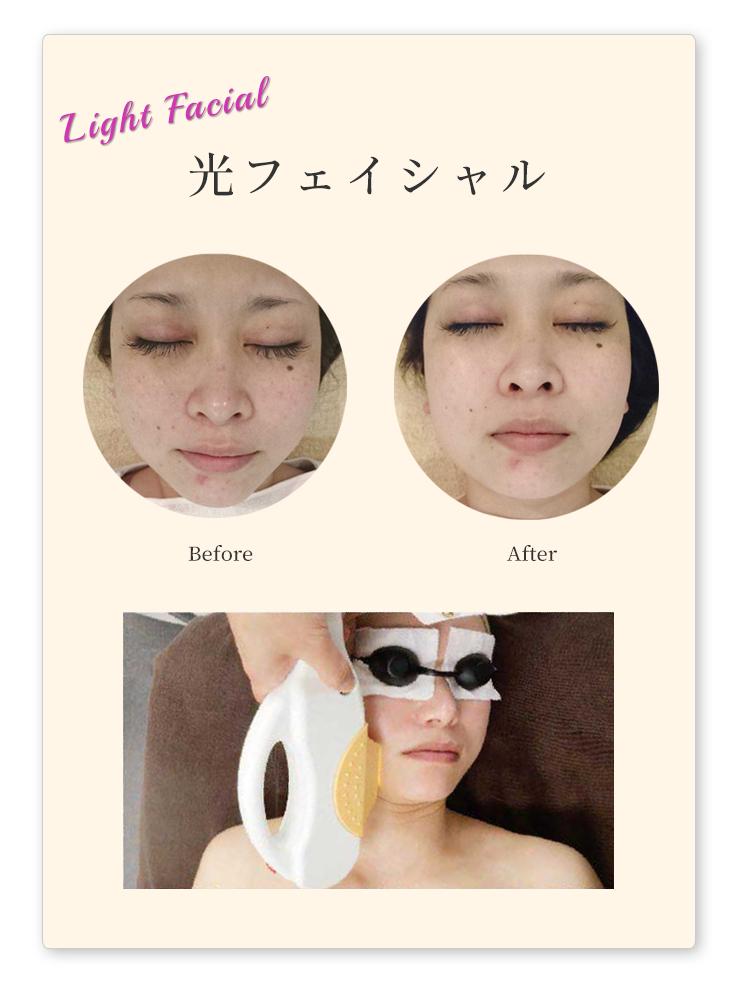ヴェリテ津幡の光フェイシャル・光美容