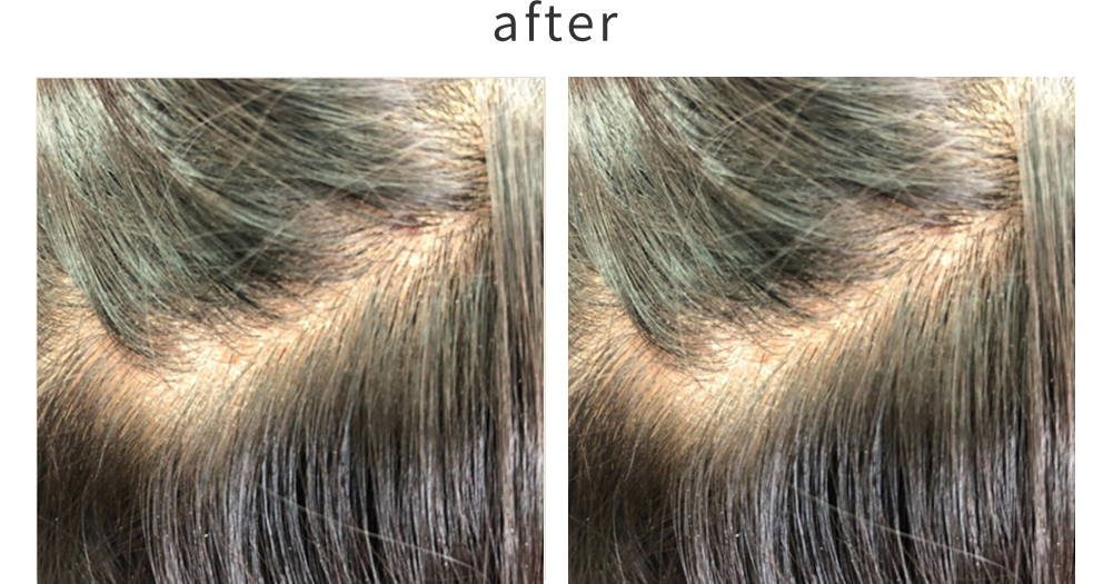 アレルギー体質の方、ホームカラーでかぶれた頭皮の方のカラー後