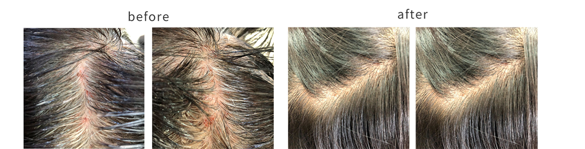 アレルギー体質やホームカラーでかぶれた頭皮の方のカラー前後