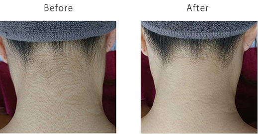 ヴェリテのNPL脱毛、レディースうなじ脱毛施術前・施術後