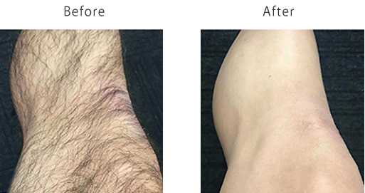 ヴェリテのNL脱毛、メンズひざ下脱毛・スネ毛脱毛・施術前・施術後