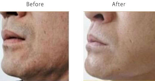 ヴェリテのNPL脱毛、ひげ脱毛施術前・施術後