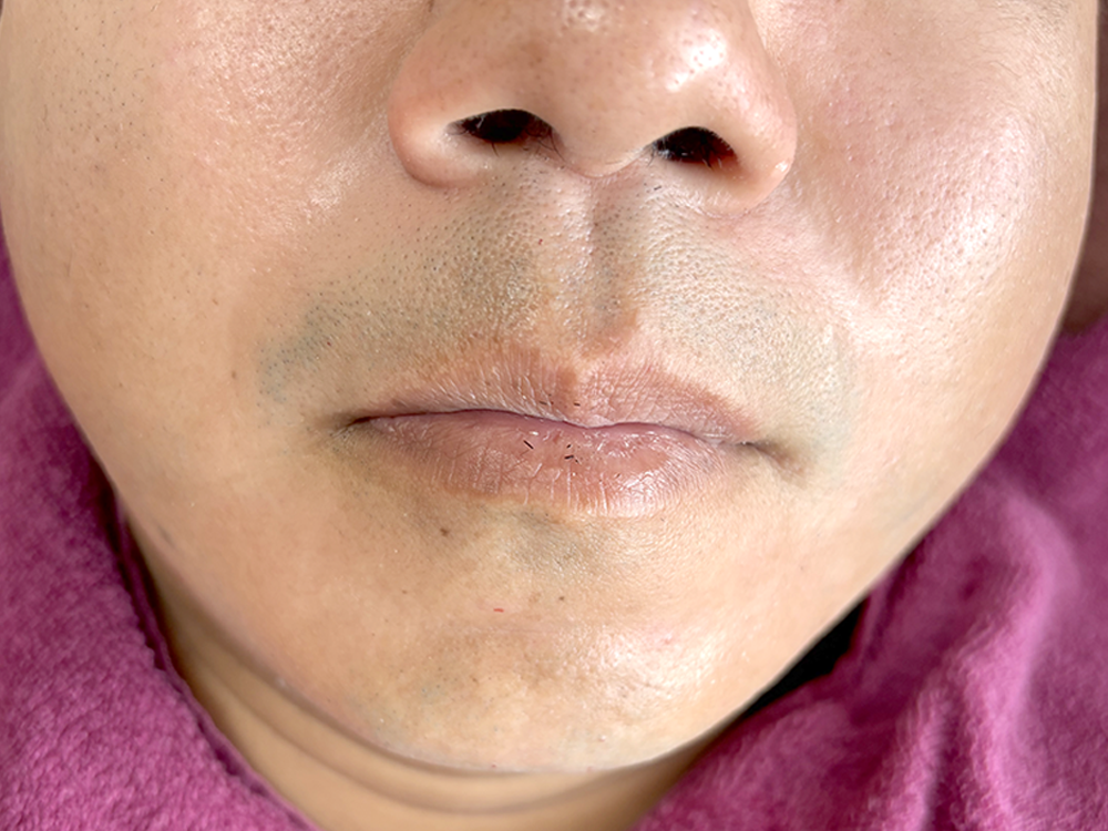 ヒゲ脱毛2回目照射後