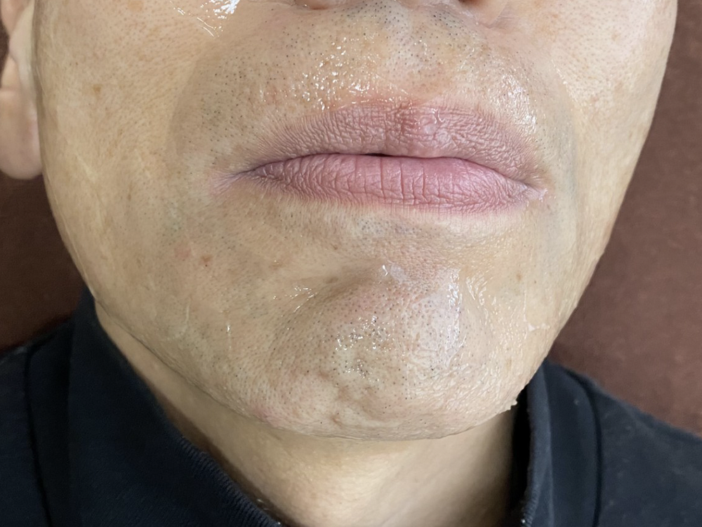 ヒゲ脱毛5回目照射後